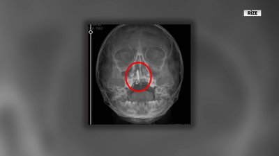 Küçük kız 2 yıl burnunda zincirle yaşadı